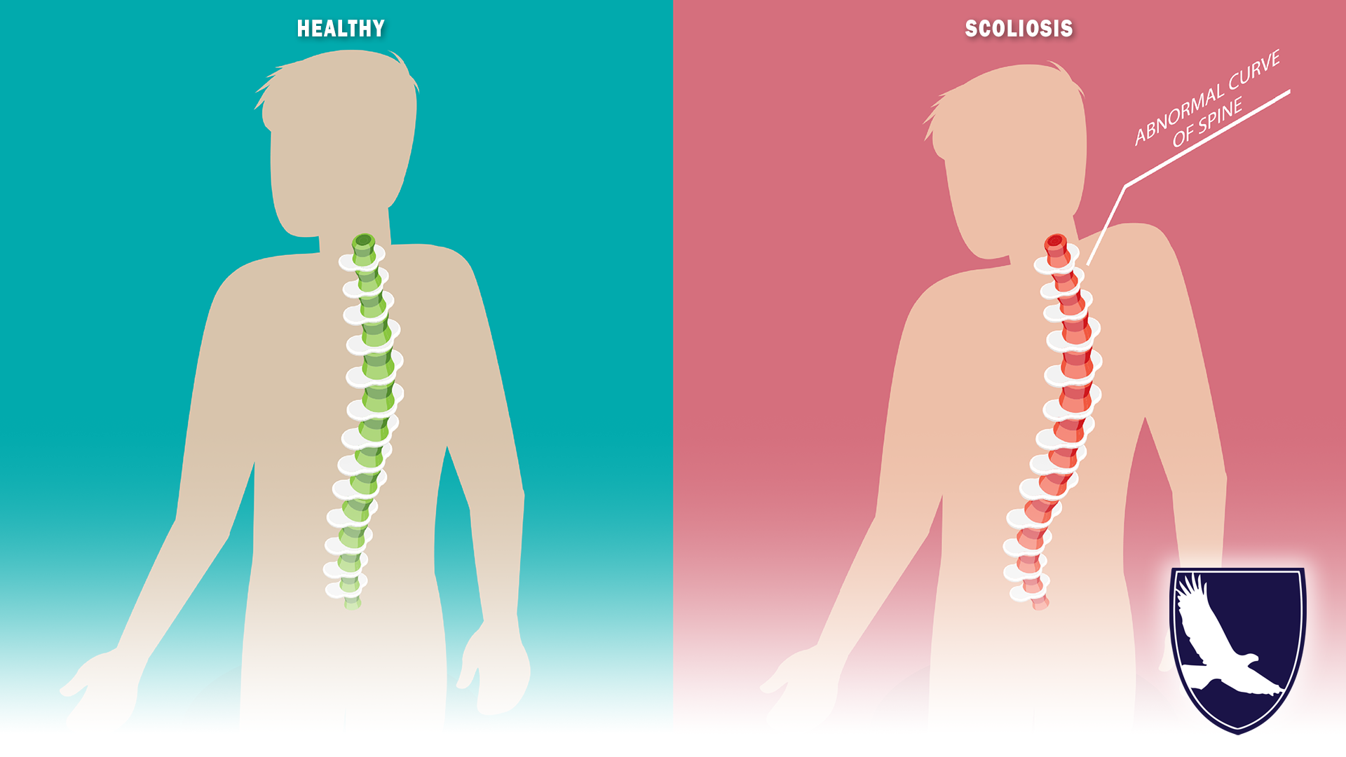 CAN I GET SOCIAL SECURITY DISABILITY IF I HAVE SCOLIOSIS